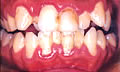 歯周病の治療前