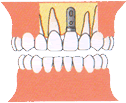前歯部一本欠損の場合：インプラント治療
