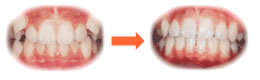 八重歯・デコボコ（叢生）　治療前・治療後